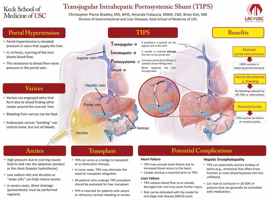 Transjugular Intrahepatic Portosystemic Shunt Diagram