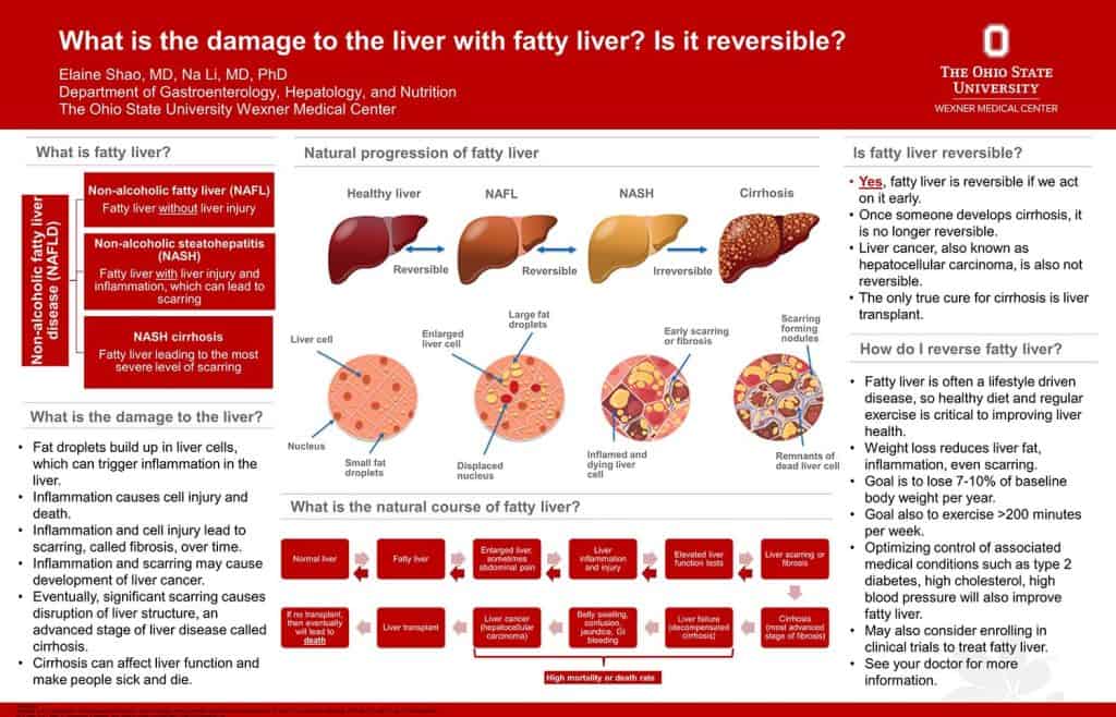What is the Damage to the Liver with Fatty Liver? Is it Reversible ...