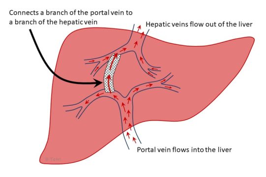 Transjugular Intrahepatic Portosystemic Shunt: TIPS