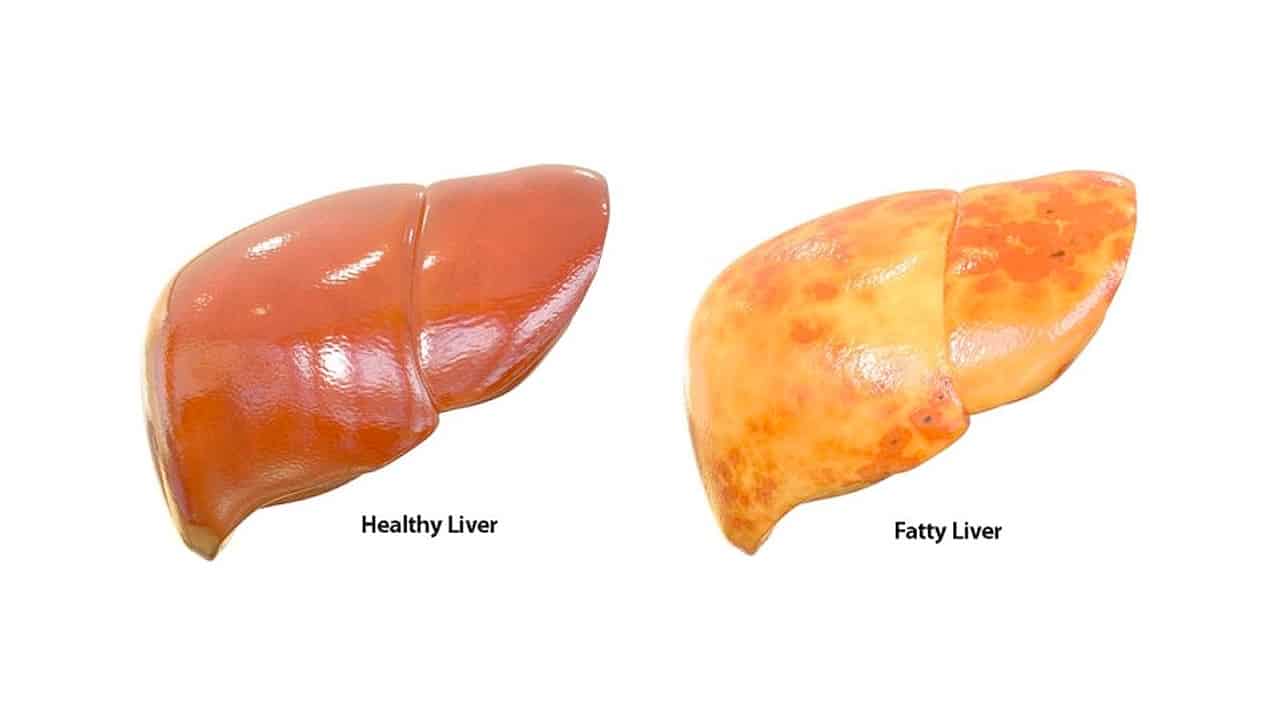 What is the Damage to the Liver with Fatty Liver? Is it Reversible?