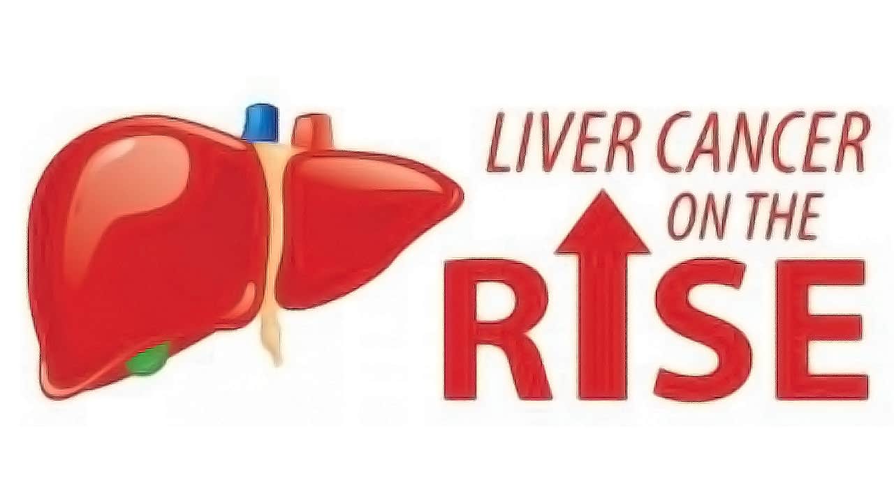 Liver Cancer On The Rise 1 