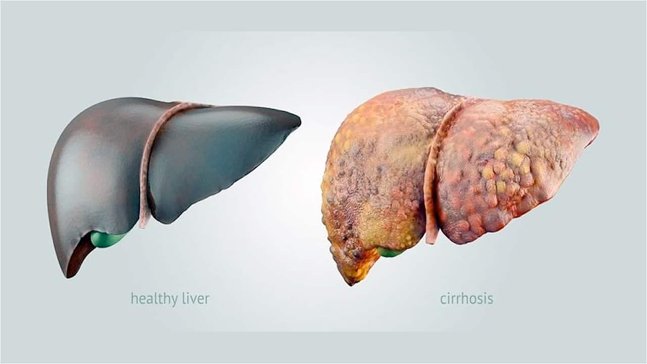 Progression of Liver Disease Webcast Series: Stages of Liver Disease