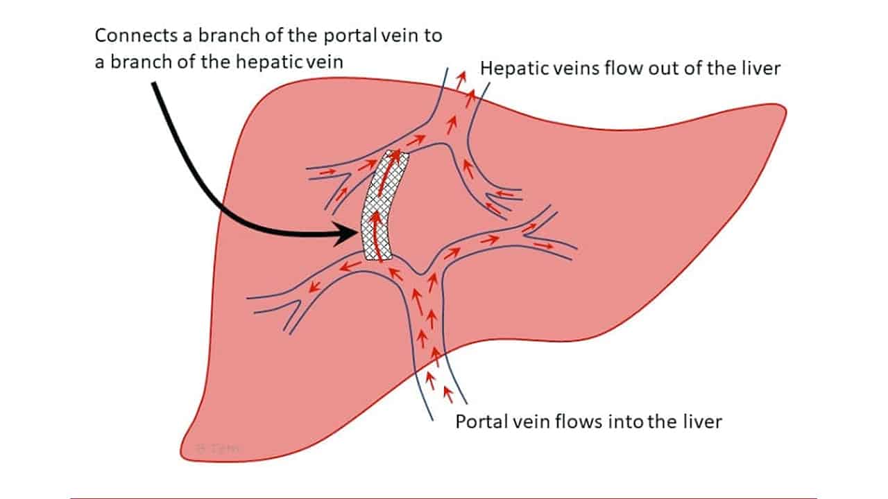 hepatic vein vs portal vein