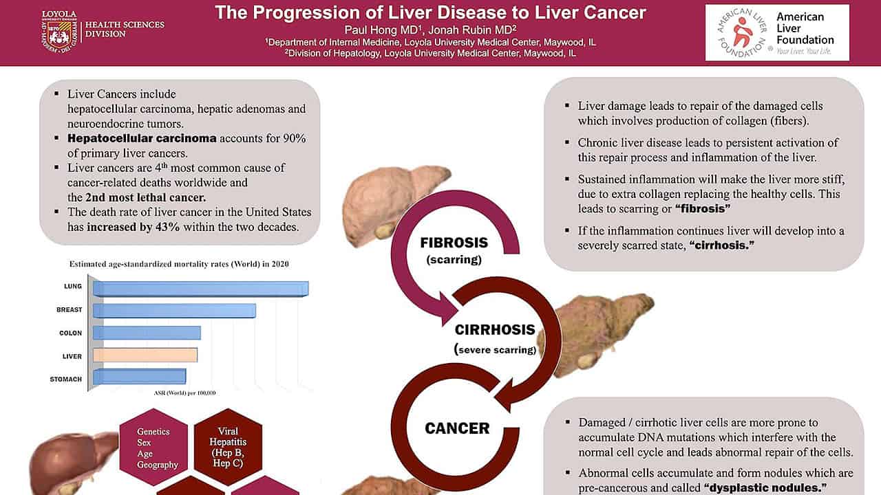 La progresión de la enfermedad hepática al cáncer de hígado
